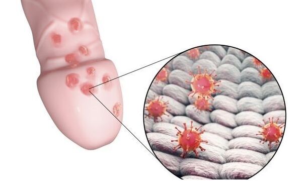 alergija na gel za povečanje penisa