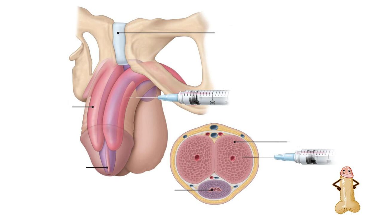 injekcije hialuronske kisline za povečanje penisa